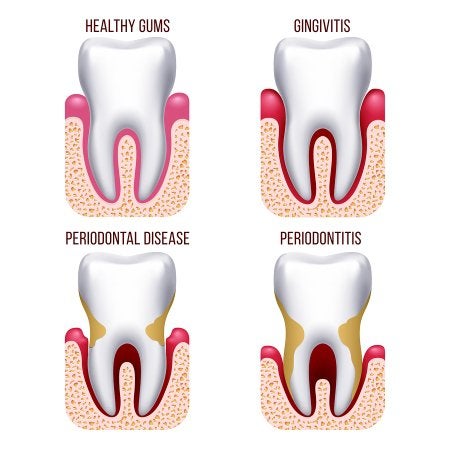 Gum Disease Austin, TX Smile 360 Vincent Ip, 53% OFF