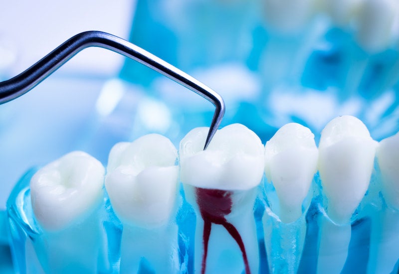 Root Canal Myths