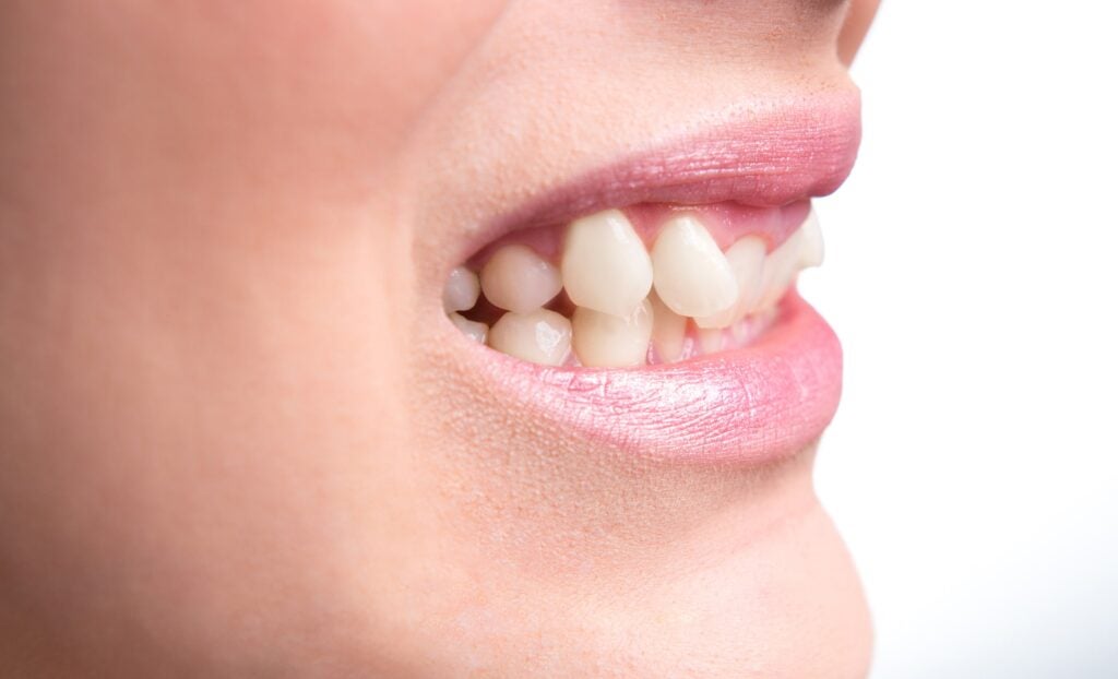 Close up of misaligned teeth.