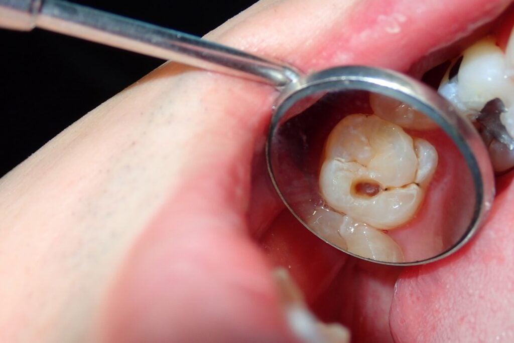 Dentist inspecting cavity.