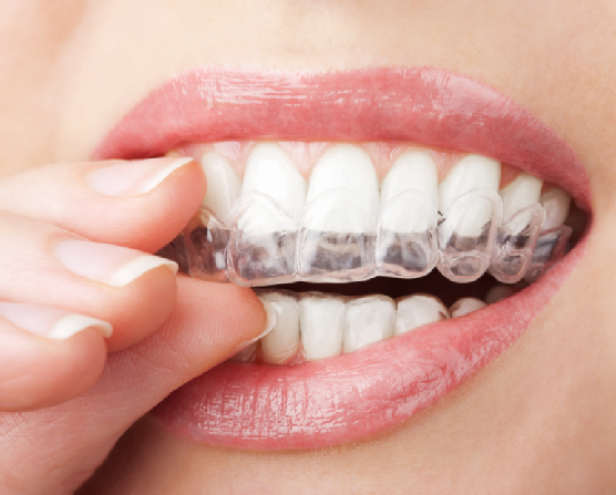 teeth with whitening tray