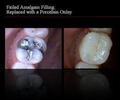 fillings