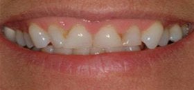 veneers