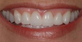 veneers